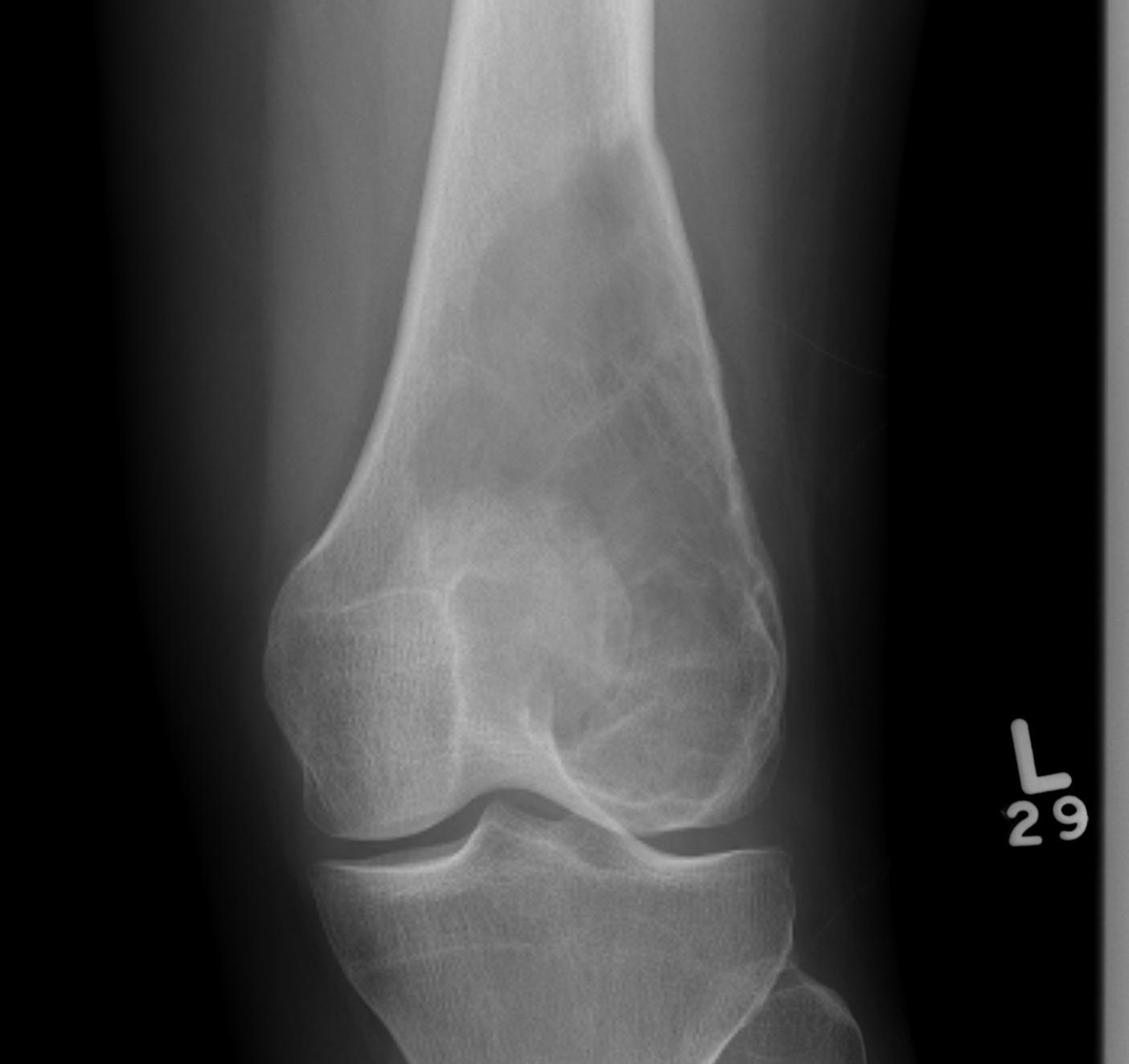 ABC Distal Femur